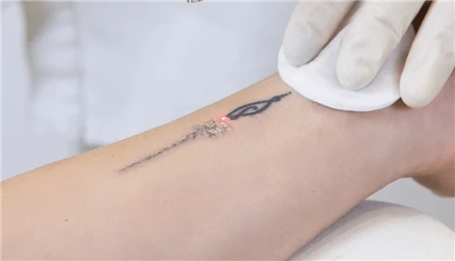 Wie viel kosten Q-switched Laser-Tattooentfernungsgeräte?