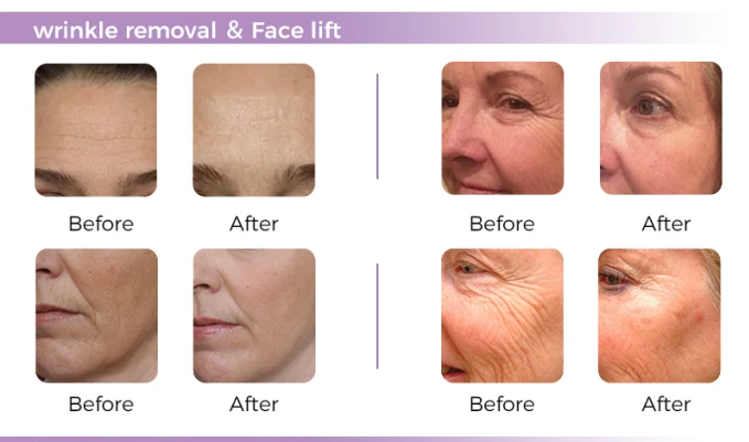 Anti Aging HIFU Machine Anti Aging HIFU Machine